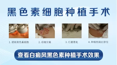 白癜风手术后如何保养