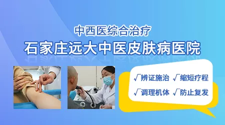 白斑在伍德灯下是瓷白色