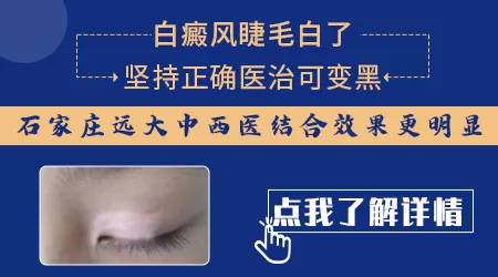 白癜风睫毛变白了还能恢复吗