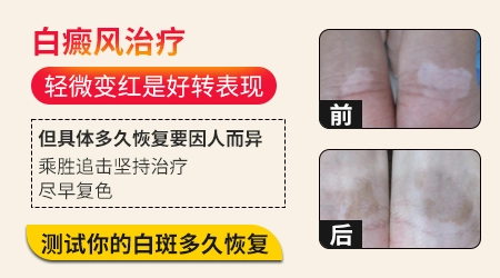 私处有白癜风照光会不会影响生育