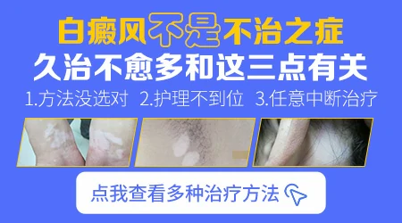 白癜风用什么药擦好