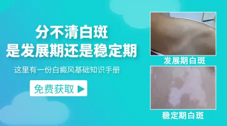 白斑几年了都没有变化是不是没事