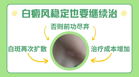 白斑几年了都没有变化是不是没事