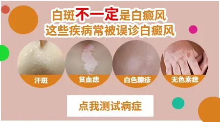 长白斑可能是白癜风吗