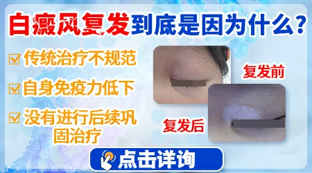 308激光治白癜风会复发吗