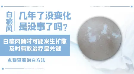 白斑从小就有十几年了没变化