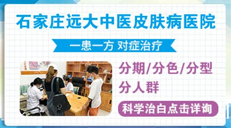 白斑在手上怎么治才能根除