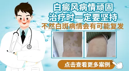 白斑黑色素移植和308激光哪个更好点
