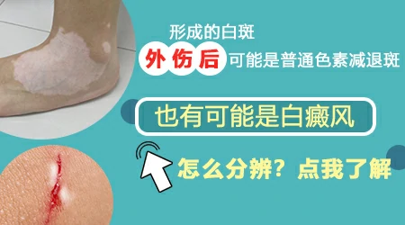 外伤后出现白斑是不是白癜风