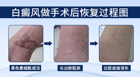 白癜风黑色素种植手术大概费用多少