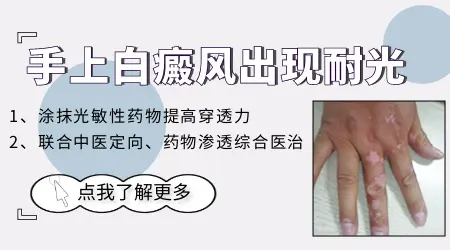 白癜风照308激光出现耐光性怎么办