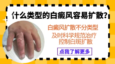 晕痣型白癜风会不会扩散
