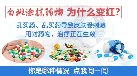 用药后白癜风白斑发红正常吗
