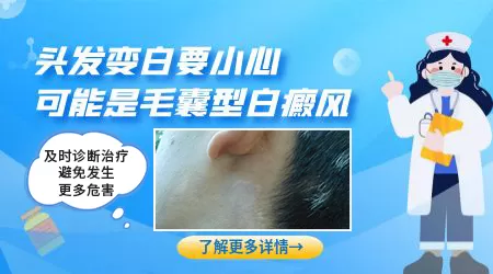 白斑处毛发变白是不是病情恶化