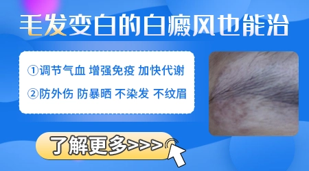 白斑处毛发变白是不是病情恶化