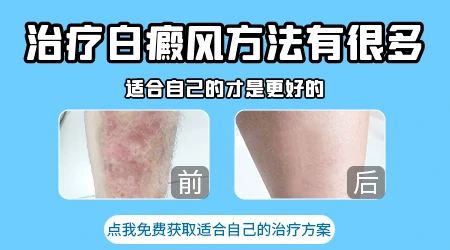 哪种方法治疗白癜风效果更好更快