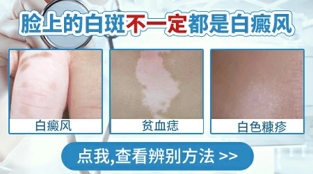 如何辨别孩子脸上的白斑是哪种皮肤病