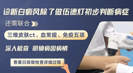 伍德灯误诊白癜风的案例多不多