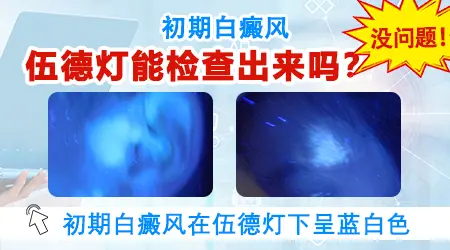 白癜风初期照伍德灯什么样子