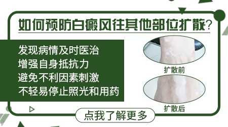 白癜风会不会一直扩散到全身