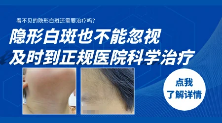 伍德灯检测有隐形白斑需要治疗吗