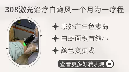 308激光治疗白癜风多久照一次合适