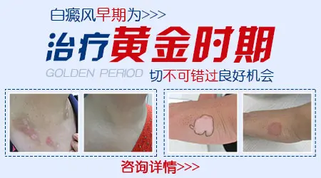 白癜风恢复后能和正常皮肤一样吗