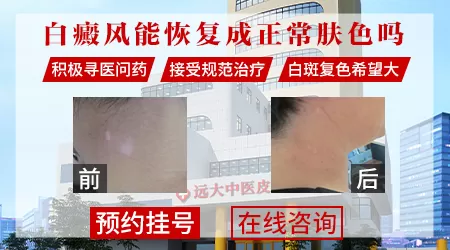 白癜风恢复后能和正常皮肤一样吗