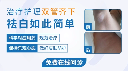 手上的白癜风怎么治好得快