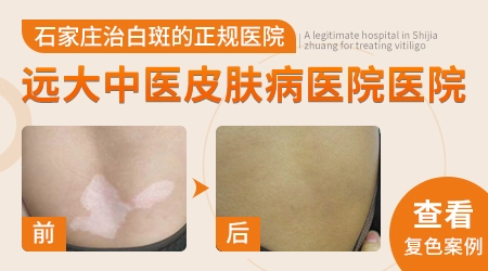 白癜风在伍德灯下的表现图片