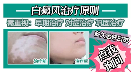 早期白癜风治愈的可能性有多少