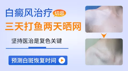 白癜风复色过程图片