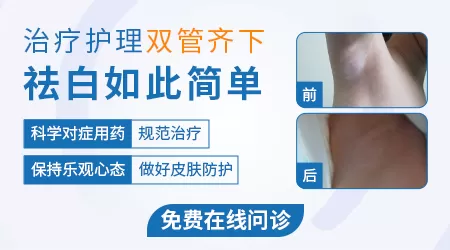 白癜风复色过程图片