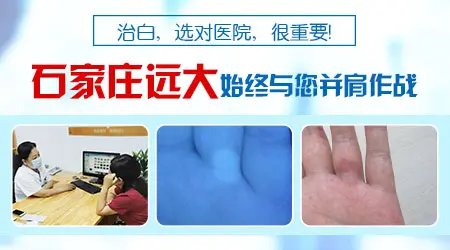 白癜风和其他白斑病症状有什么区别