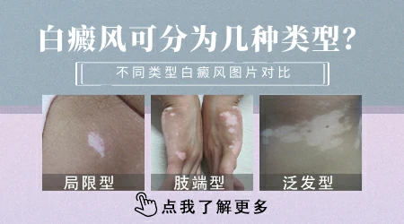白癜风分型有哪些 如何判断类型