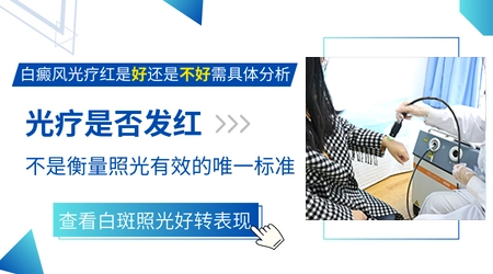白癜风照308激光后发红好还是不红好