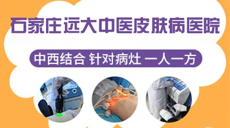 石家庄治疗白斑哪家医院最好