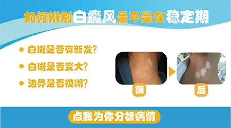 怎么判断白癜风是不是处于稳定期