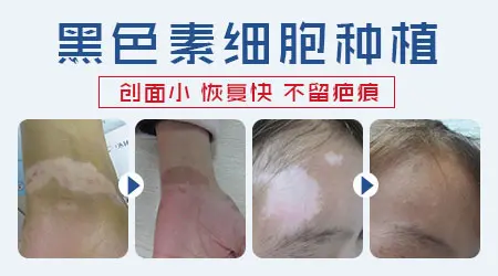 石家庄白癜风表皮移植成功率高的医院