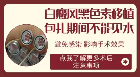 石家庄白癜风表皮移植手术哪家医院成功率高
