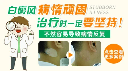 稳定期白癜风308照不出色素岛怎么办