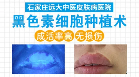 白癜风表皮移植和黑色素细胞移植区别在哪