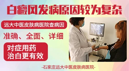 做什么检查能查出白癜风病因