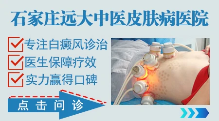 石家庄治白癜风比较好的医院是哪家