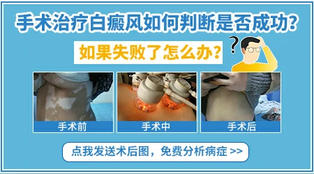 白癜风如果手术失败还有哪些补救手段