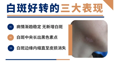 白癜风好转过程会有什么症状图片