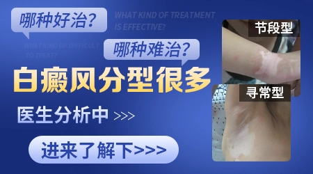 早期白癜风能治到完全看不出吗 治愈率大概多少