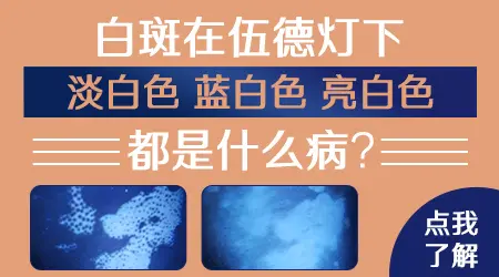 白斑在wood灯下亮蓝白色严重不严重