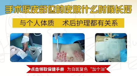 白癜风种植手术后3个月不复色是失败吗