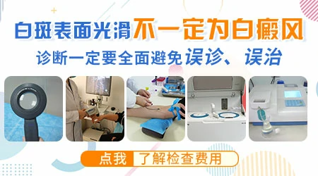 白斑表面光滑没皮屑就是白癜风吗
